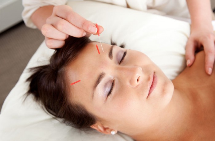 Mei Zen Cosmetic Acupuncture Treatment