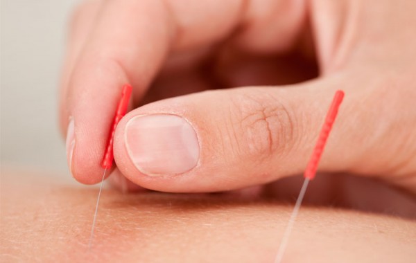 Initial Assessment & Acupuncture (new patients)