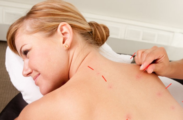 Follow-up Acupuncture Treatment