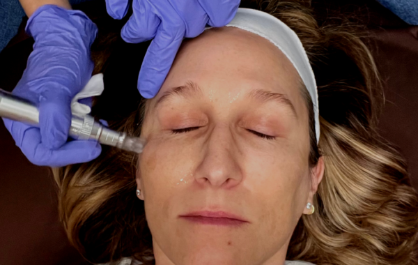 Microneedling: Collagen Induction Therapy